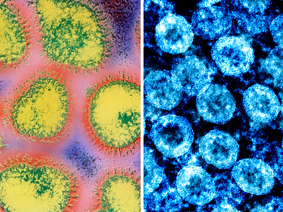 How The Novel Coronavirus And The Flu Are Alike … And Different